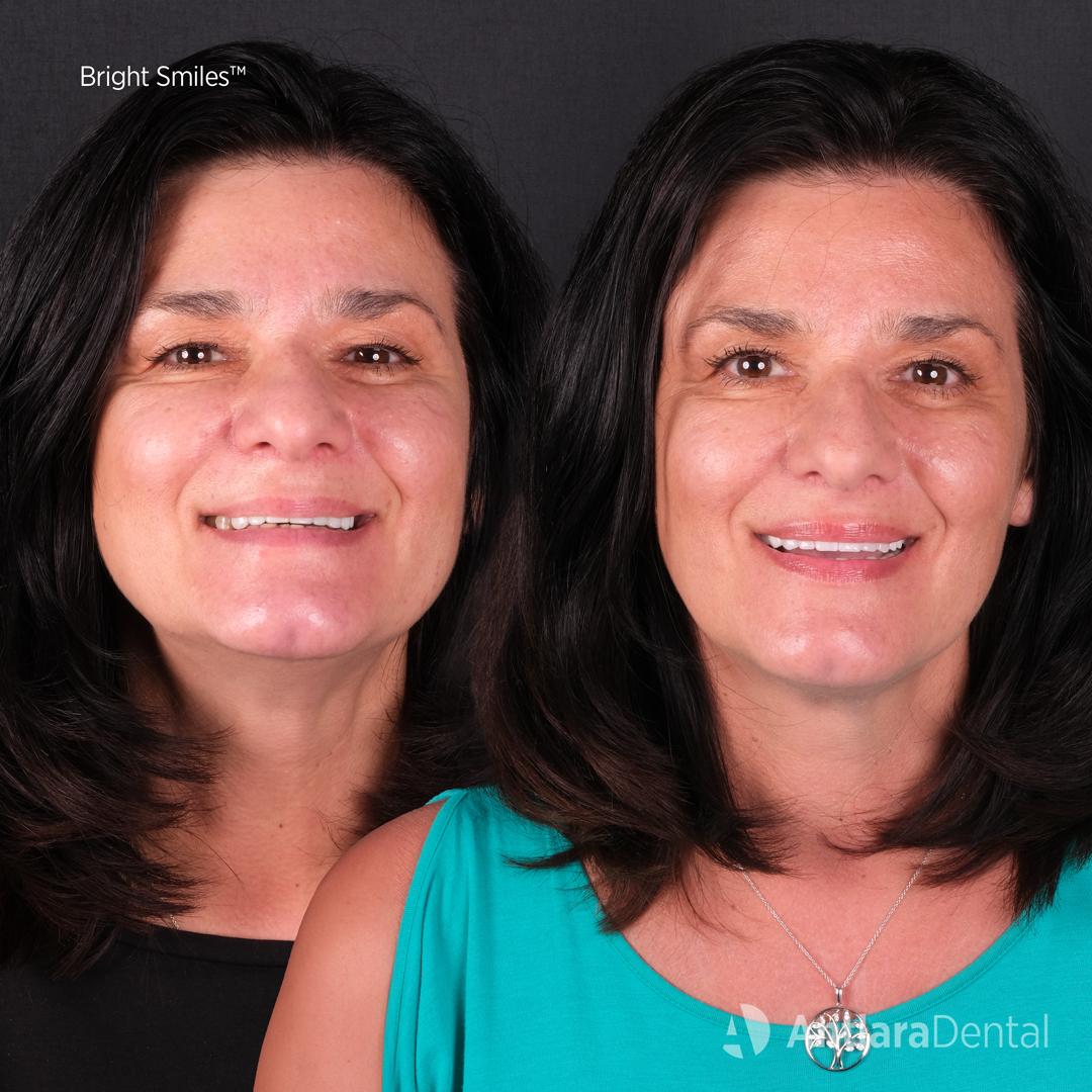 Turkey teeth before and after case