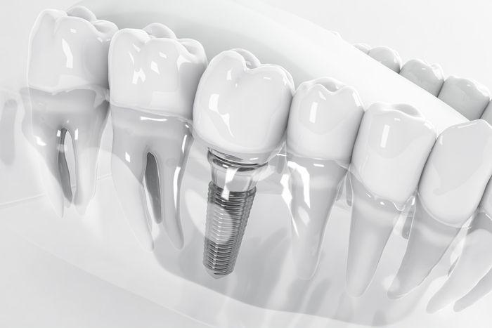 Transparent 3D model of a jaw with an implant and crown