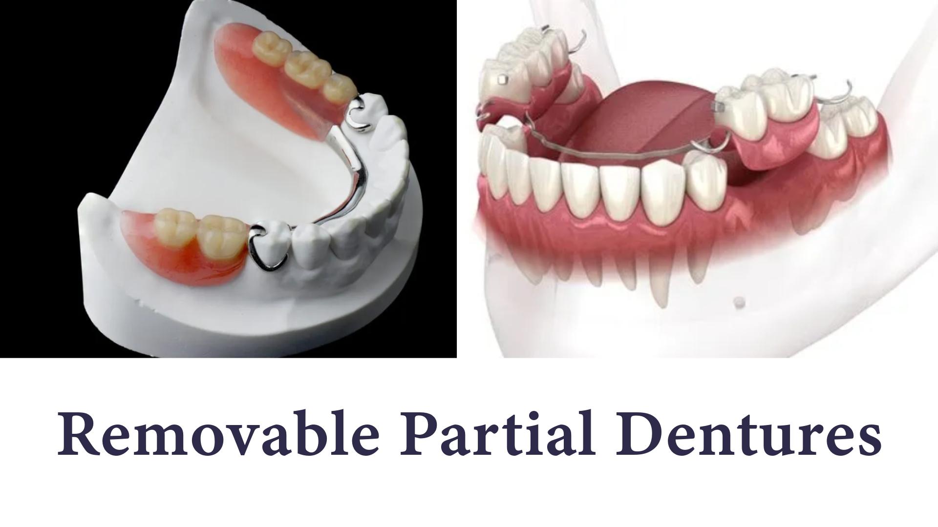 Removable partial denture on a plaster cast and in an illustration