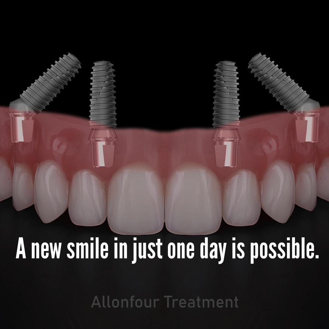 Rendering of four angled implants holding a fixed upper bridge on a dark background