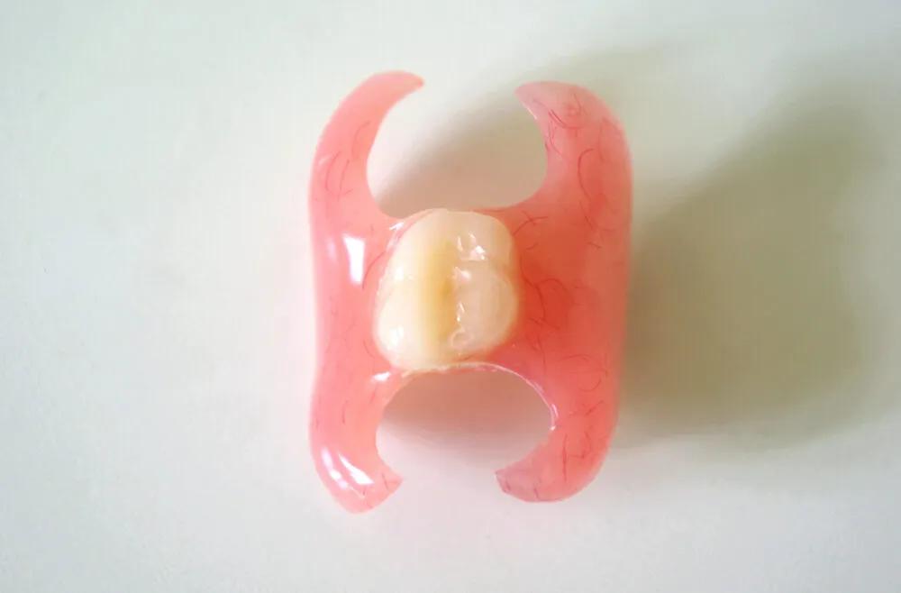 Acrylic (temporary) partial denture (flipper)
