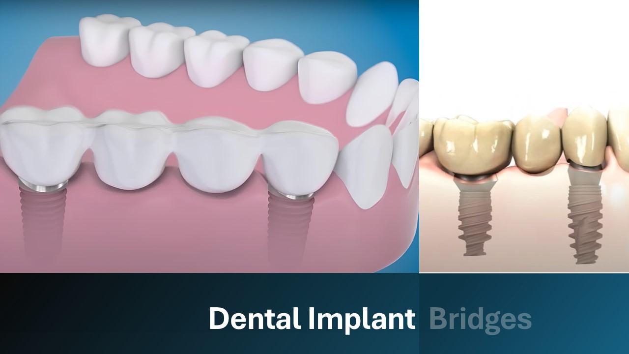 3D renders of a dental bridge supported by two implants