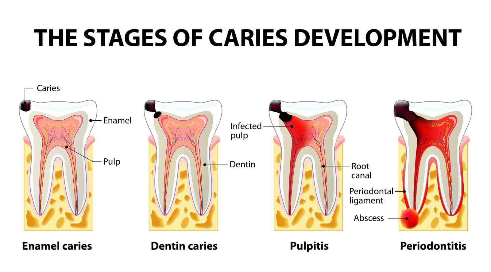 Diagram of the four stages of tooth decay from enamel caries to periodontitis