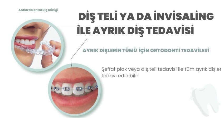 Diş teli ve şeffaf plak uygulaması örnekleri