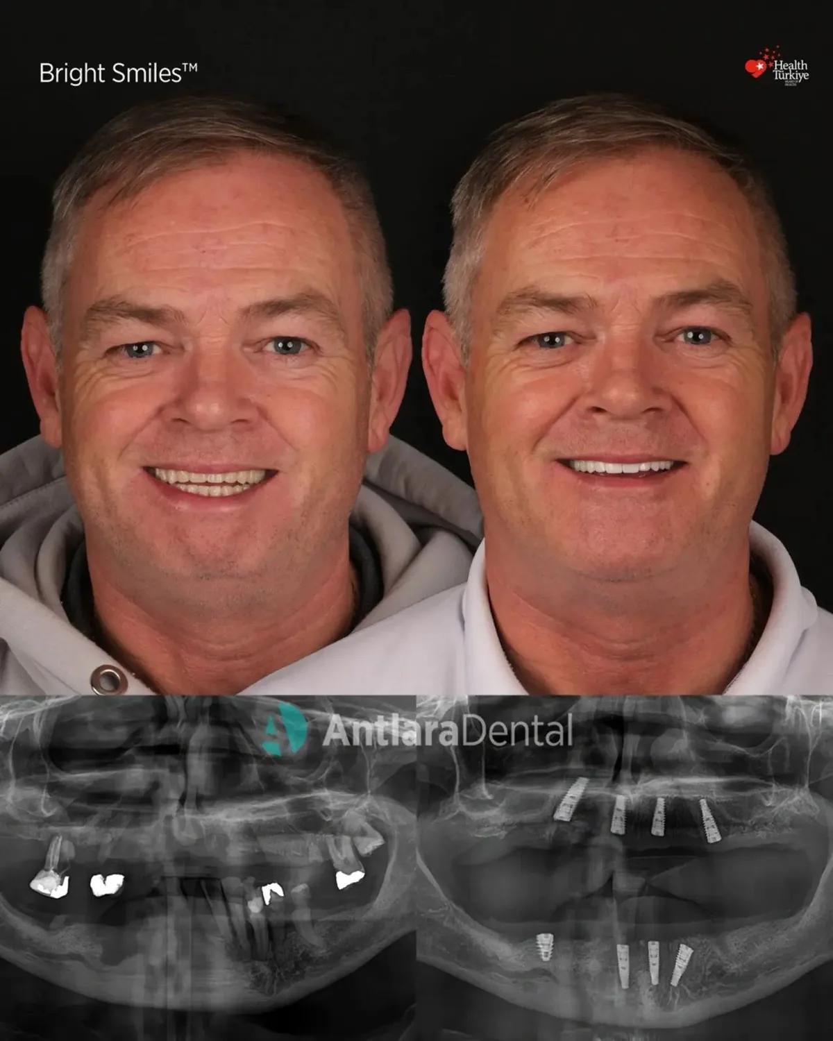 All-on-4 dental implants before and after with panoramic x-ray, patient two