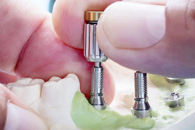 Installation of the abutments all on 6 implant