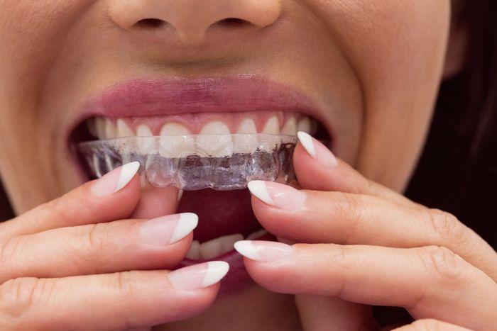 Person fitting a clear aligner over their teeth