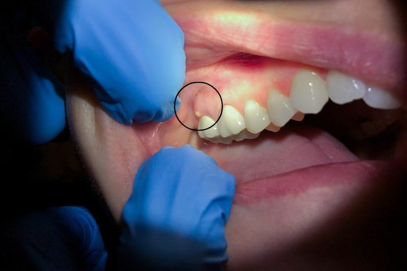 Circled gum swelling near an upper front tooth