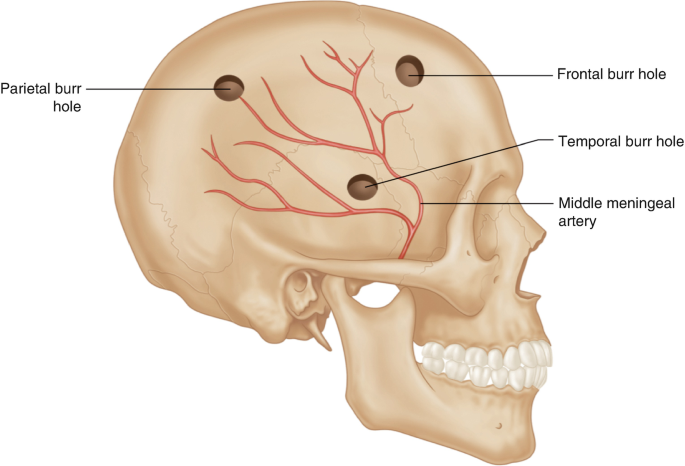 Neurosurgery