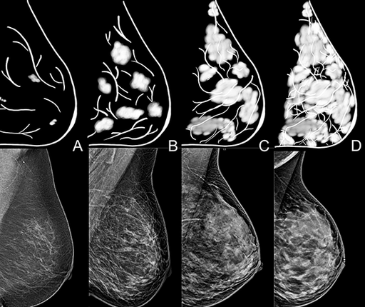 Examples of breast density as seen in mammorgrams