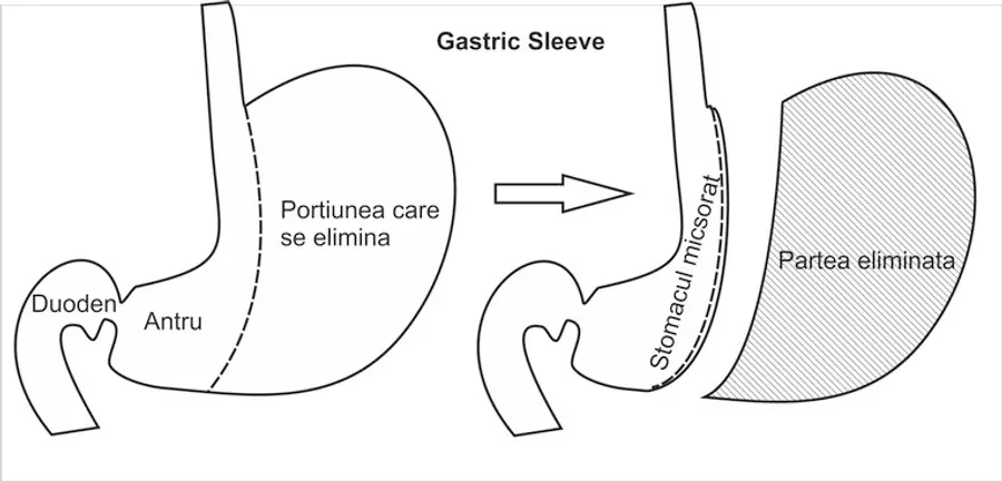 Gastric Sleeve