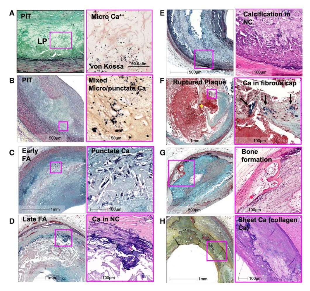 Silent Shifts Beneath the Surface: Patterns of Arterial Calcification