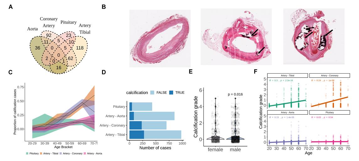 Age-Related Patterns of Soft Tissue Calcification Across Human Organs
