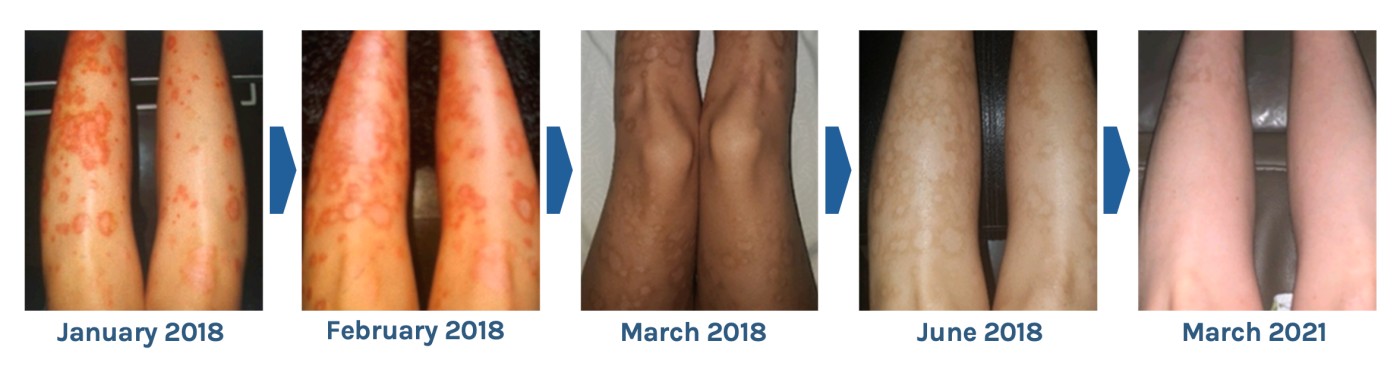 A patient’s legs with psoriasis photographed from January 2018 to March 2021, the plaques clearing over time