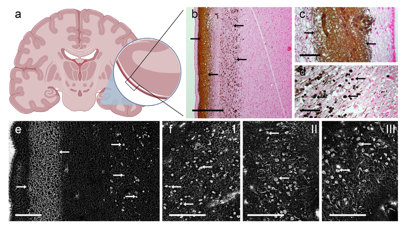 Microscopic View of Brain Calcification Patterns in Aging and Alzheimer’s Disease