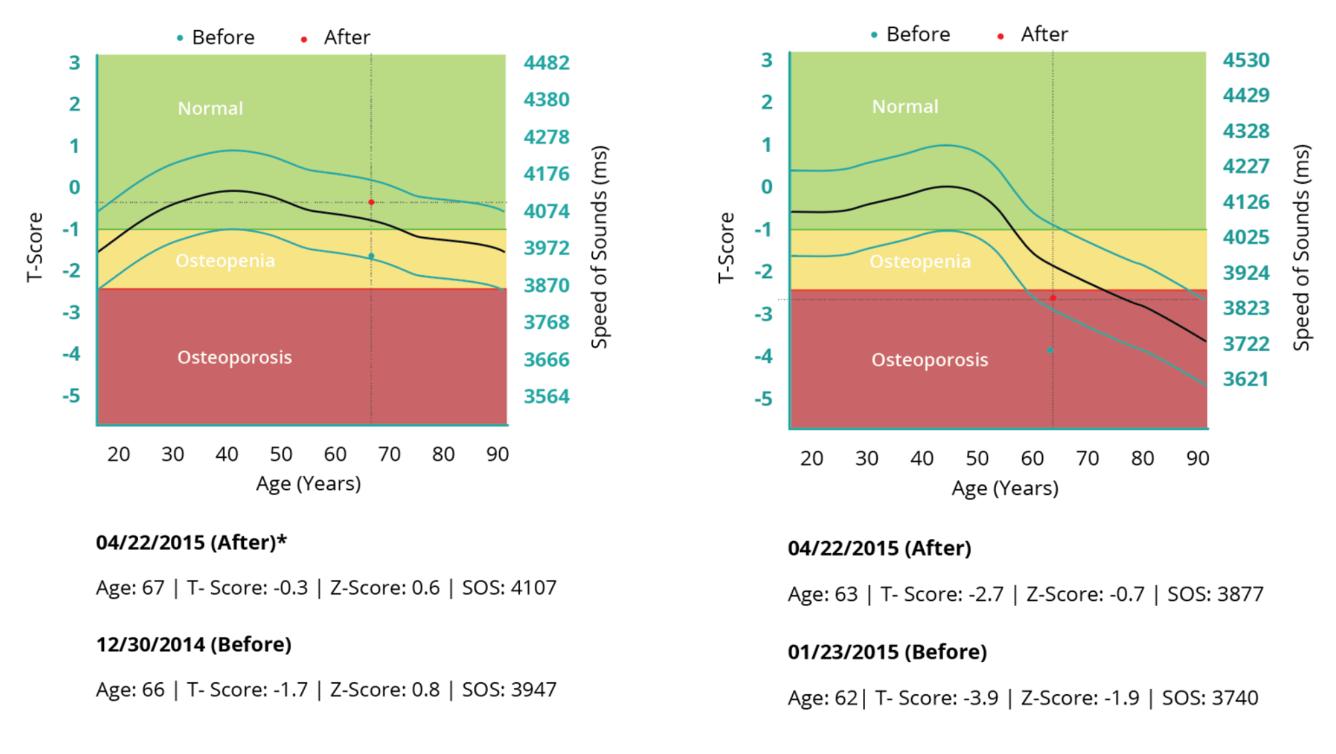 Bone density charts for two patients before and after AIC therapy, showing T-scores, Z-scores and speed-of-sound readings