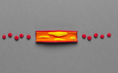 Treatment of vascular atherosclerosis, cholesterol plaques in the veins. Cartoon concept.