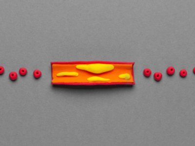 Treatment of vascular atherosclerosis, cholesterol plaques in the veins. Cartoon concept.