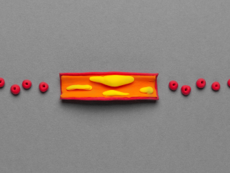 Treatment of vascular atherosclerosis, cholesterol plaques in the veins. Cartoon concept.