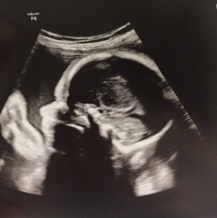 El ginecólogo dijo: “Tu placenta no está adherida”