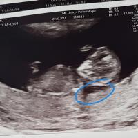 During an ultrasound, it appears that the baby has a thickened nuchal fold, followed by an amniocentesis