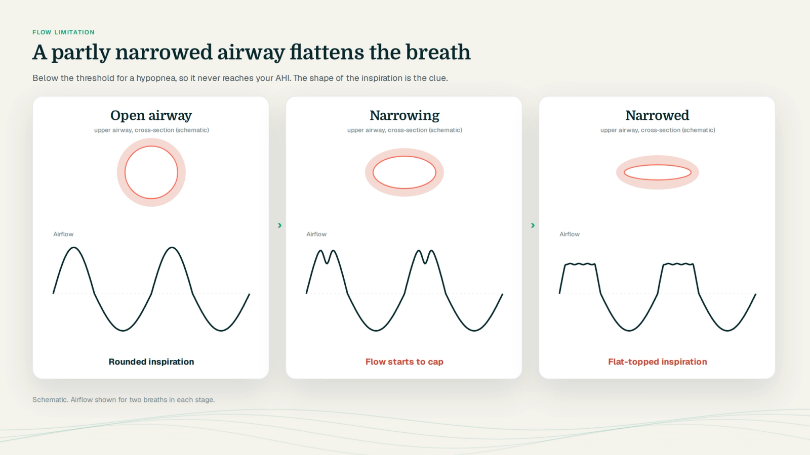 Three stages of upper-airway narrowing drawn as cross-sections, open, narrowing and narrowed, each above its airflow shape: rounded, mid-dip and flat-topped