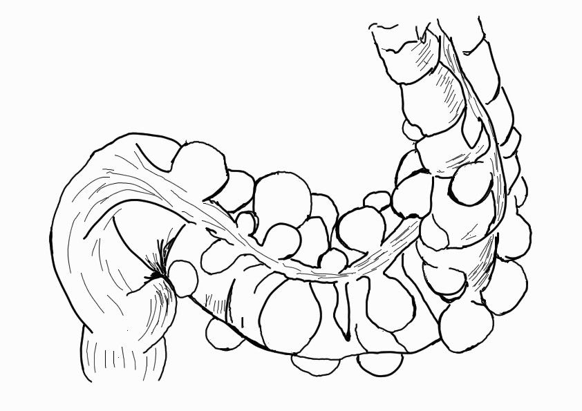 Esquema de un divertículo en el colon sigmoide