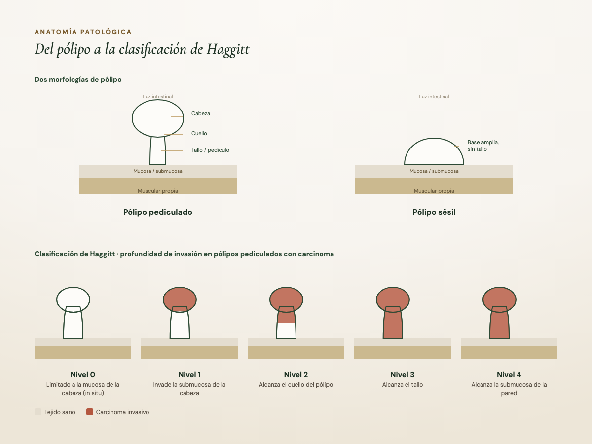 Esquema de un pólipo pediculado y sésil, y clasificación de Haggitt según la profundidad de invasión