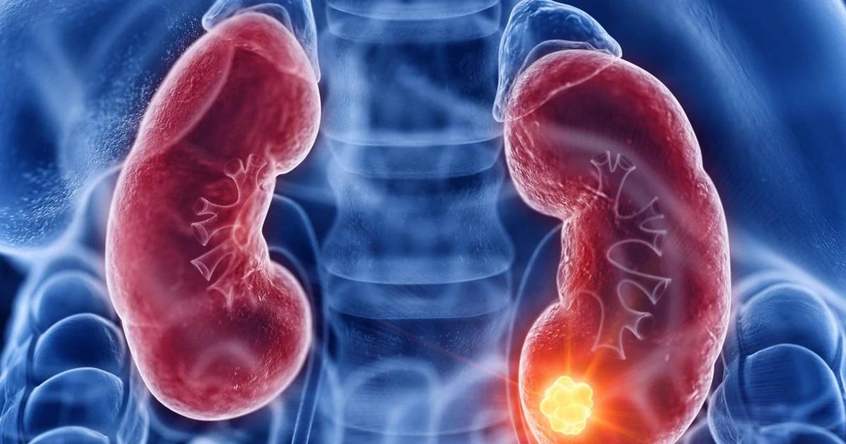 Expert Warning: The Risk of Kidney Dysfunction from Excessive Protein Intake