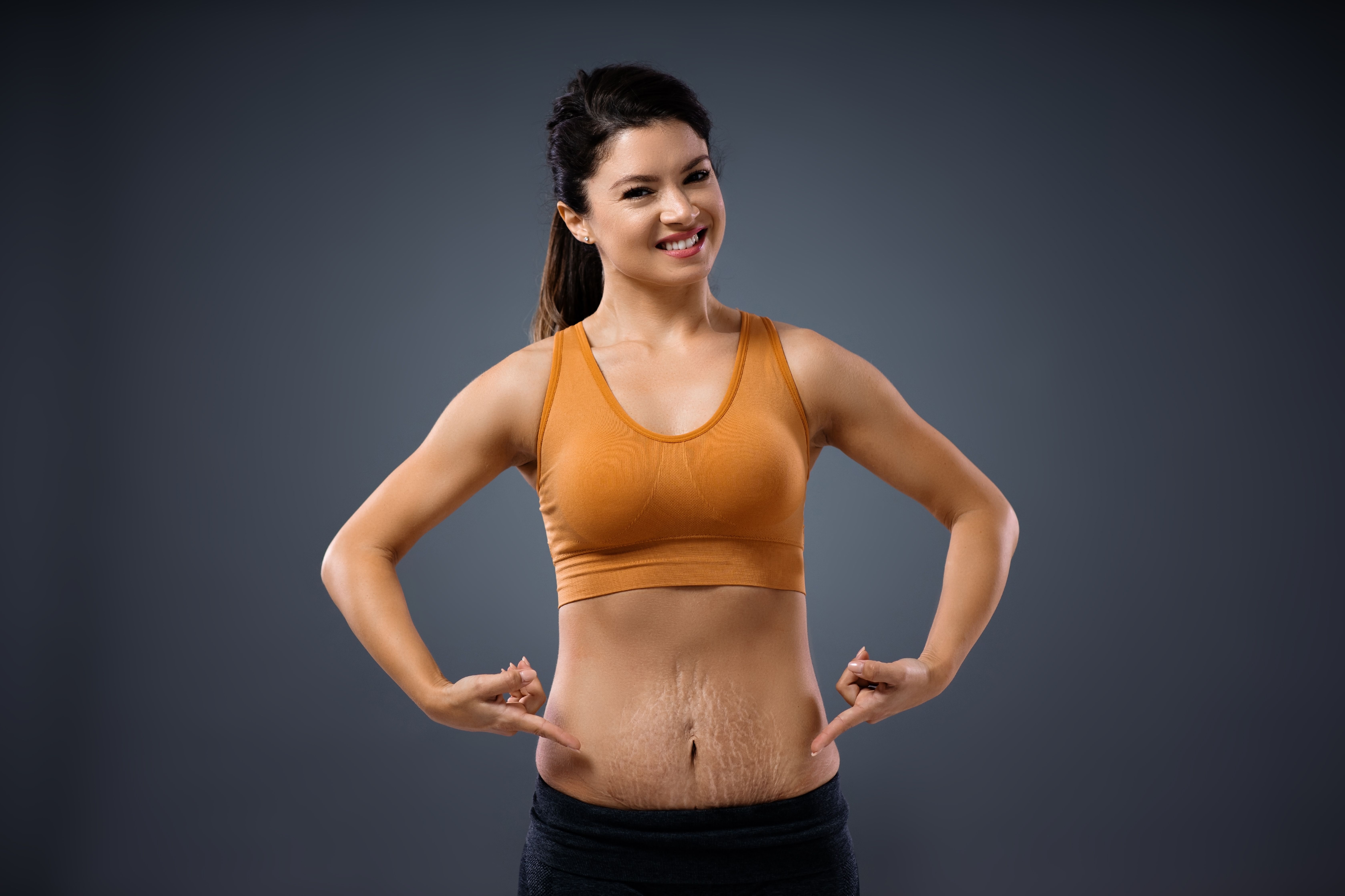 Does Exercise Make Stretch Marks Go Away?