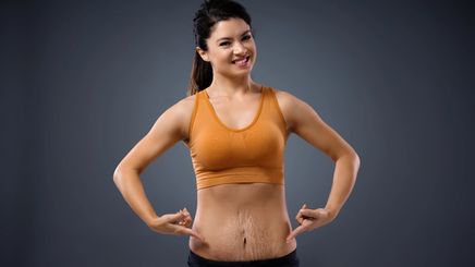 Asian women with stretch marks on belly