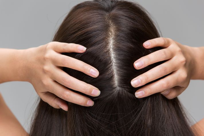 What Causes Dandruff? 4 Triggers That Might Surprise You 