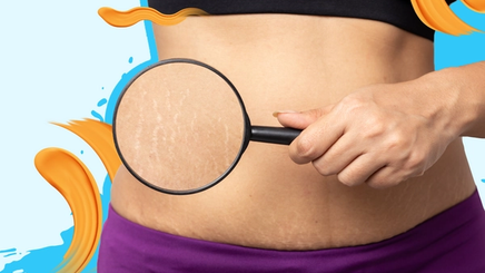 A woman holding a magnifying glass to show her stretch marks 