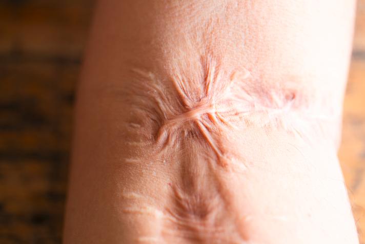 6 Types of Scars and How to Deal With Them