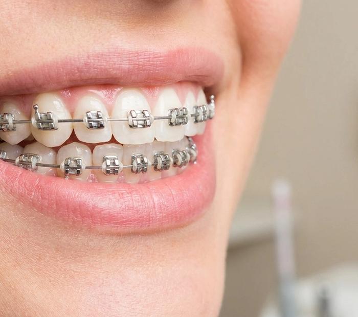 Behel & Orthodonti