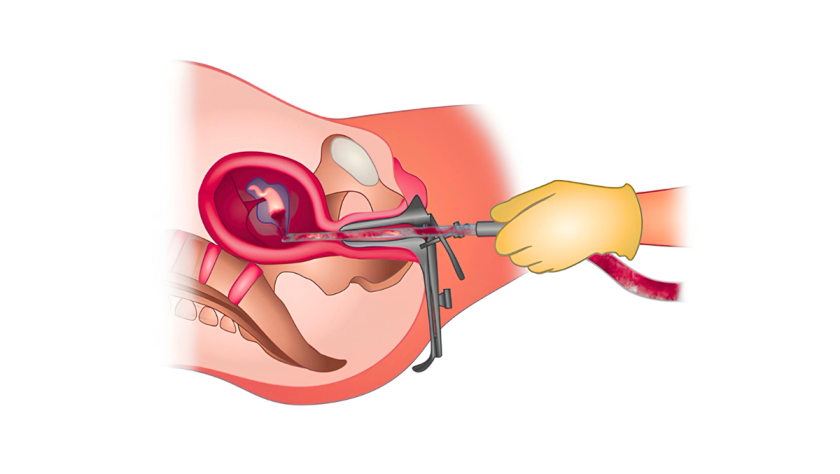 Surgical abortion treatment by Dr. Ashwani Narla in Hyderabad for safe termination