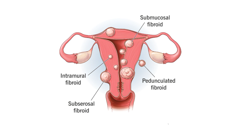 Uterine fibroid treatment by Dr. Ashwani Narla in Hyderabad for heavy periods