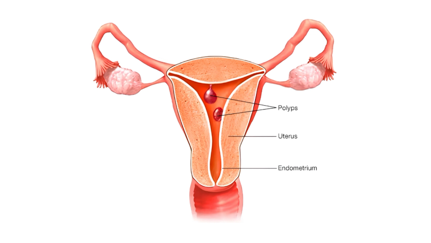 Uterine polyp removal by Dr. Ashwani Narla in Hyderabad for bleeding relief