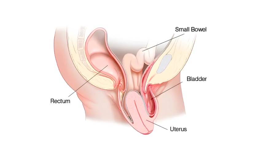 Uterine prolapse treatment by Dr. Ashwani Narla in Hyderabad for pelvic support