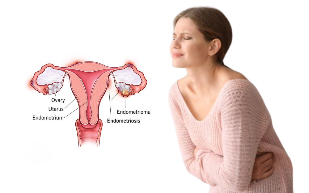 Endometriosis symptoms and treatment options