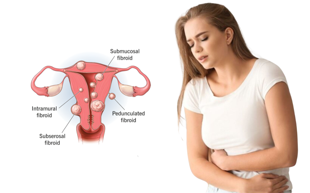 Myomectomy for fibroids procedure to remove uterine fibroids