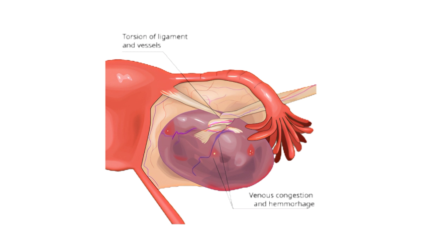 Emergency ovarian torsion treatment by Dr. Ashwani Narla in Hyderabad
