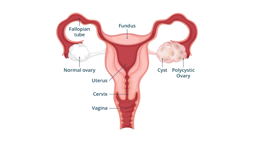 PCOS management by Dr. Ashwani Narla in Hyderabad for hormonal balance