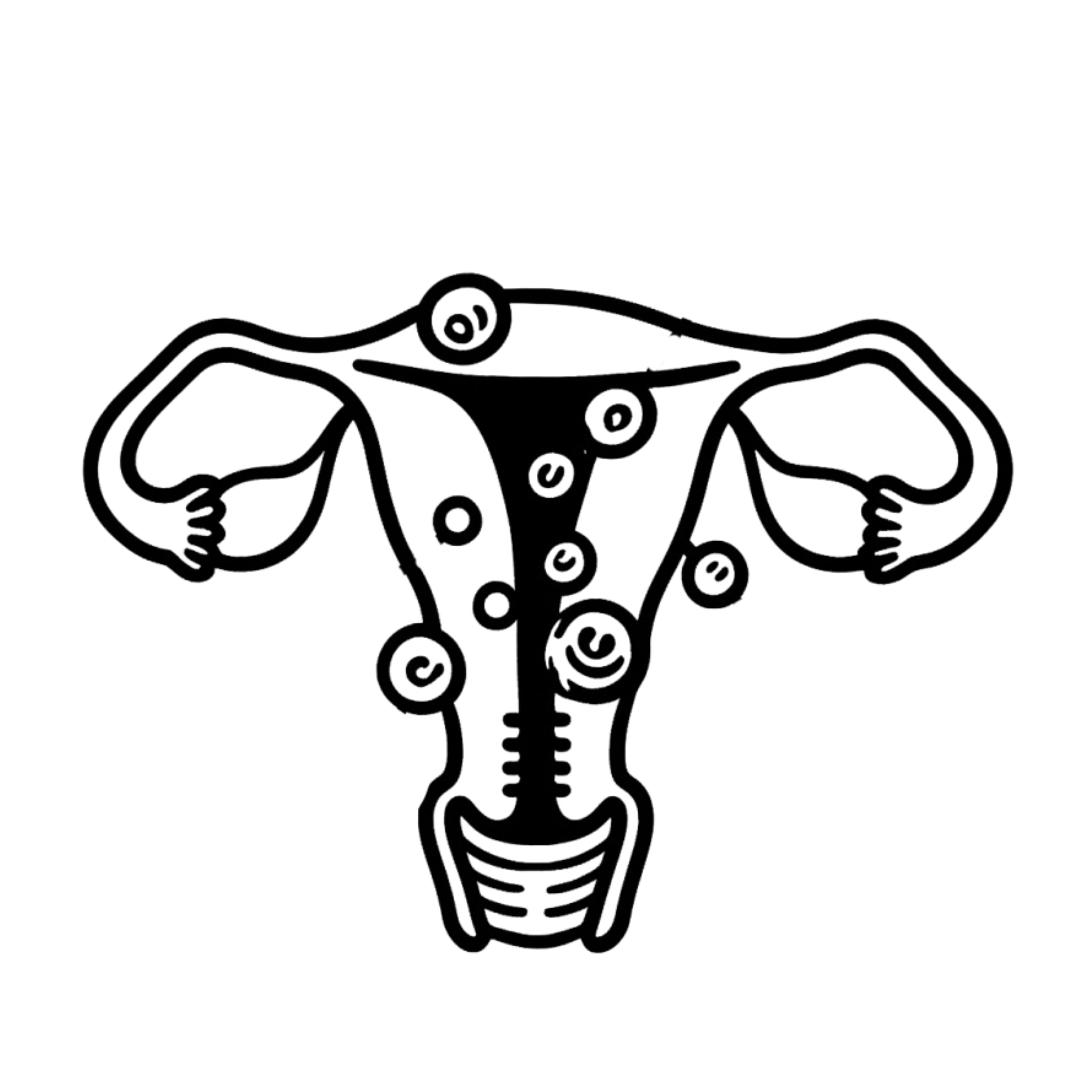 Uterine Fibroids