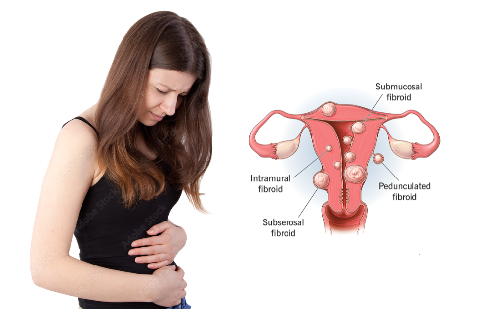 uterine fibroids