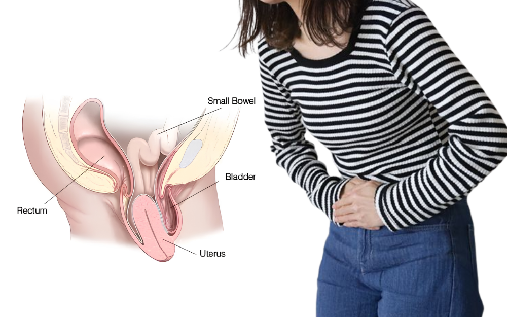 Uterine prolapse showing descent of the uterus into the vagina