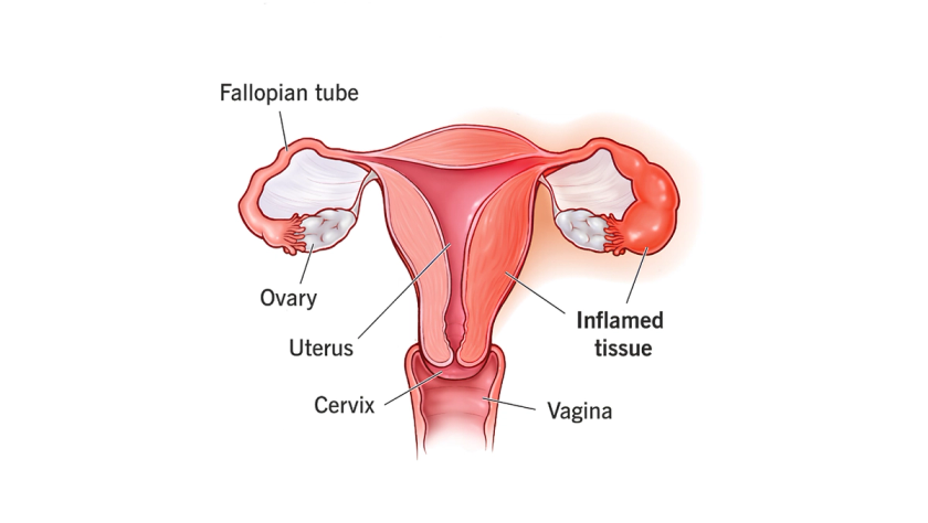 PID infection treatment by Dr. Ashwani Narla in Hyderabad for pain relief