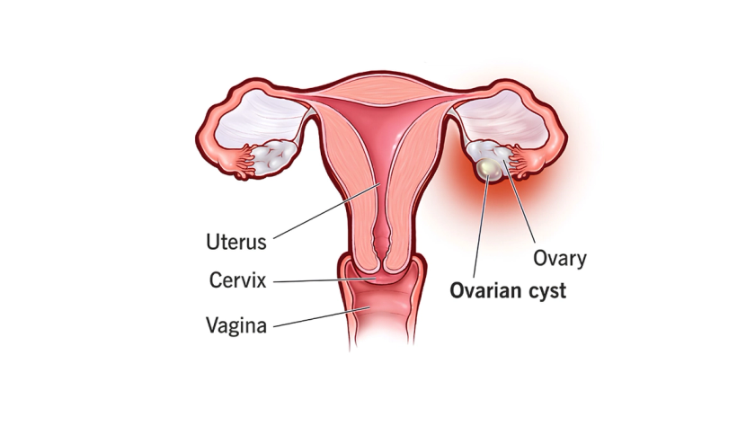 Laparoscopic ovarian cystectomy by Dr. Ashwani Narla in Hyderabad