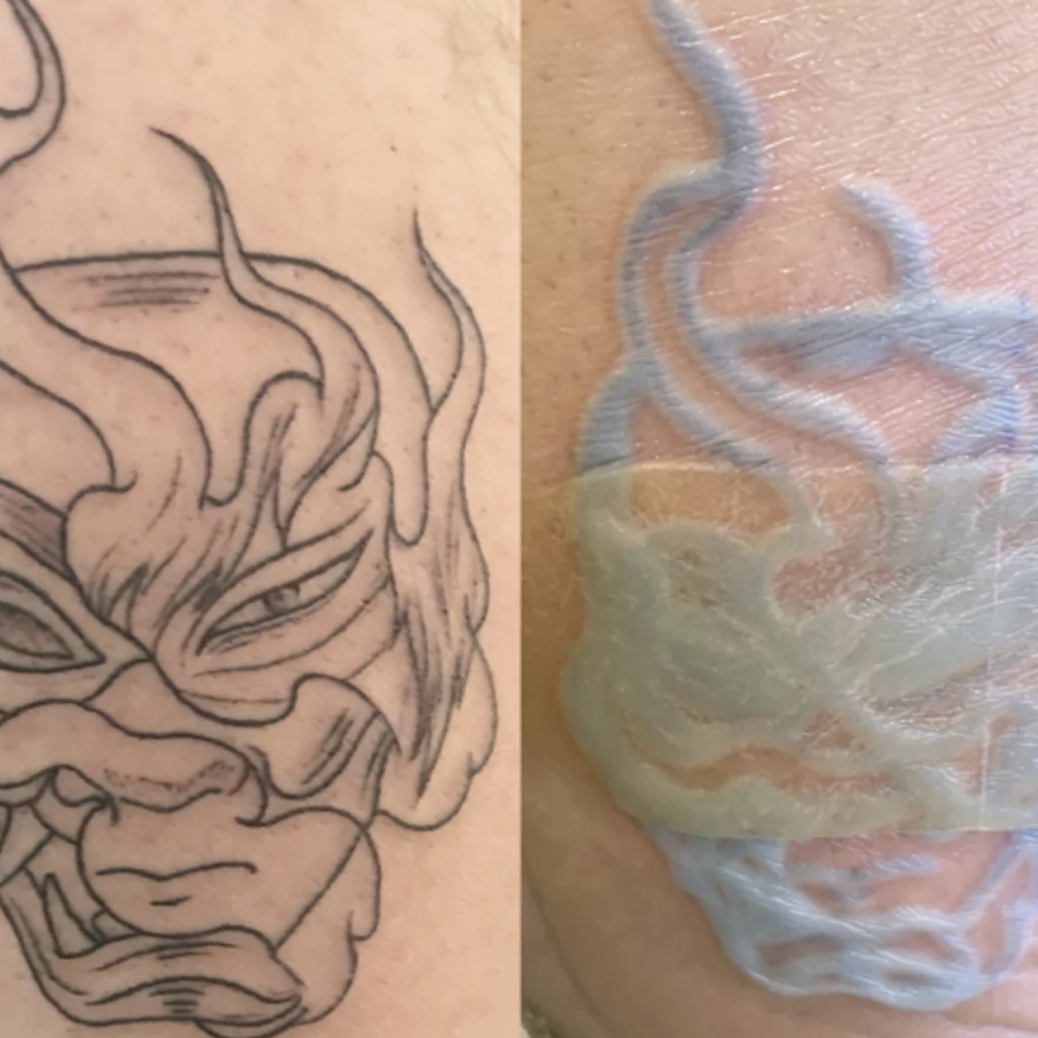 Is It Normal for a Tattoo to Peel? | Saniderm