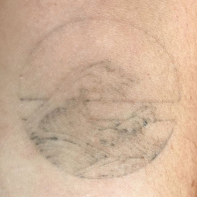 ephemeral temporary tattoo that lasts a year after 9 months
